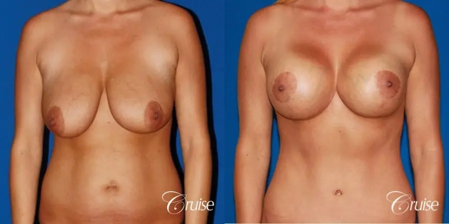 best breast lift anchor with saline implants - Before and After 1