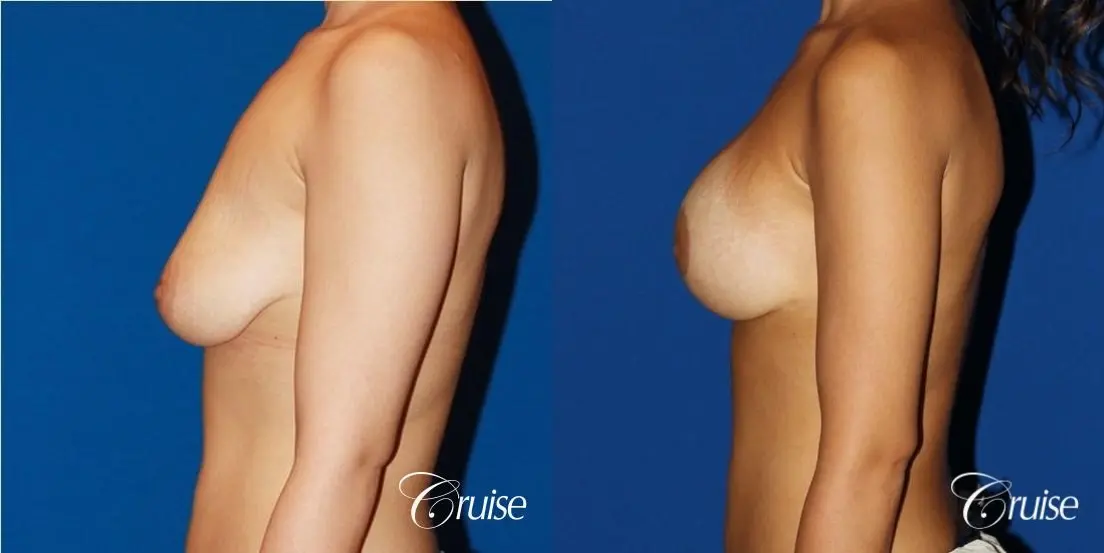 breast lift anchor with saline implants on young girl - Before and After 3