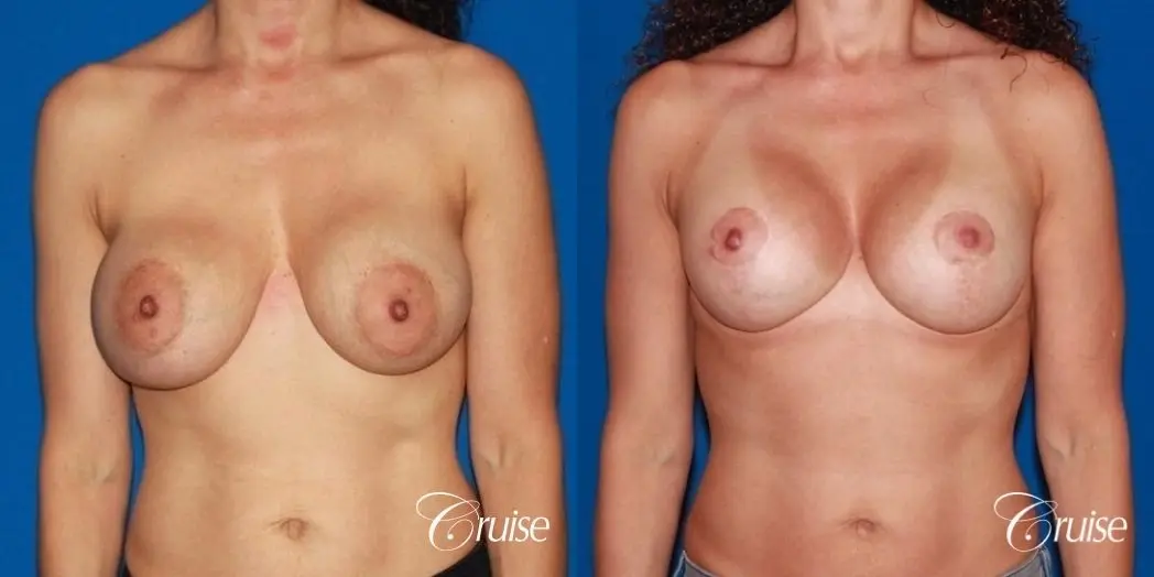 best breast lift revision with high profile silicone 425cc - Before and After 1