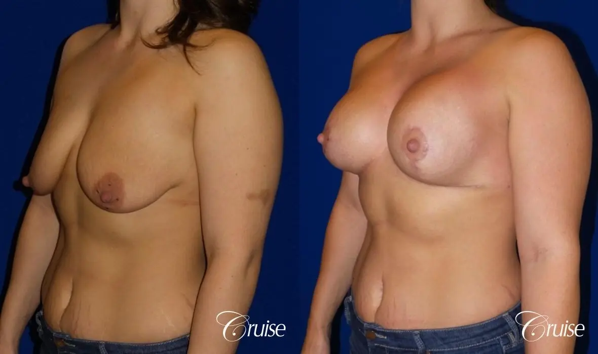 Breast Lift - Anchor w/ Saline Implants on Young Woman - Before and After 2