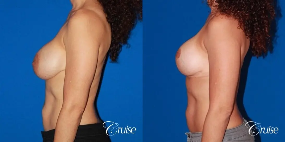 best breast lift revision with high profile silicone 425cc - Before and After 2