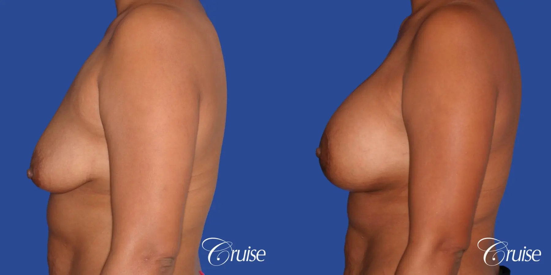 best breast lift donut with saline augmentation - Before and After 2