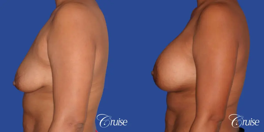 best breast lift donut with saline augmentation - Before and After 2