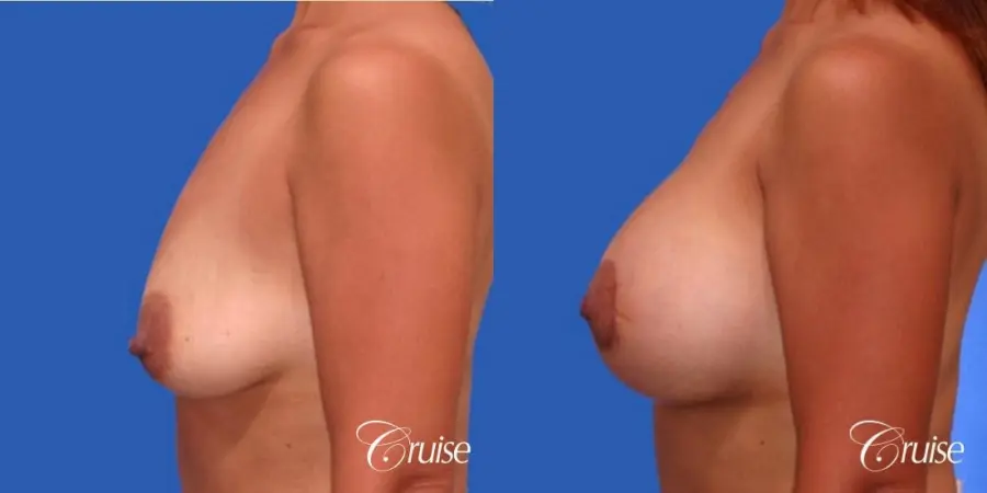 best breast lift donut before and after pictures in Newport Beach - Before and After 2