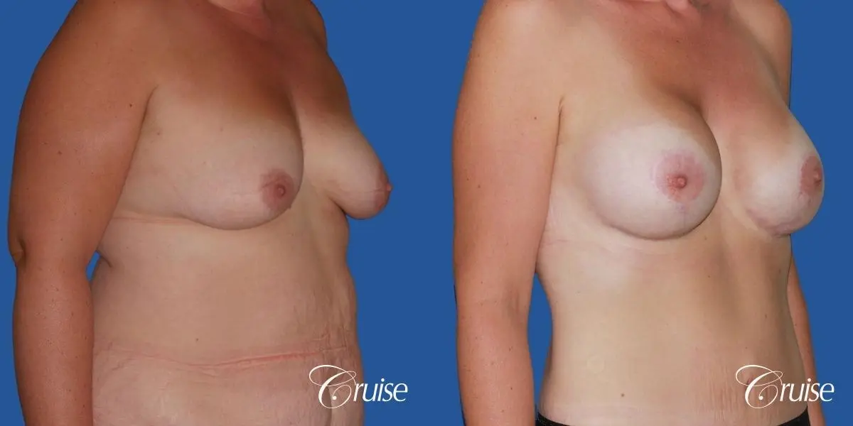 best mommy makeover and breast lift anchor results - Before and After 3