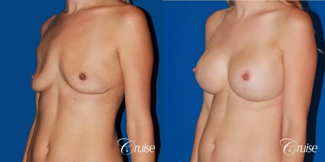 best breast lift anchor with High profile silicone 500cc implants - Before and After 3