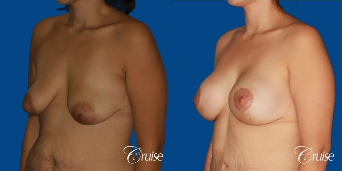 best breast lift anchor by top plastic surgeon in Newport Beach - Before and After 3