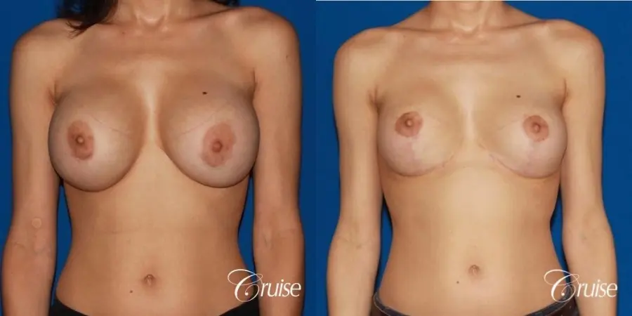 best breast lift revision with moderate profile silicone implants - Before and After 1