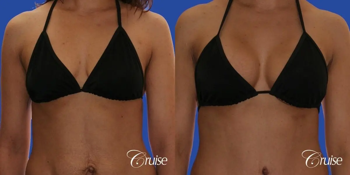 best scars for  breast lift anchor saline in Newport Beach, Orange County - Before and After 4