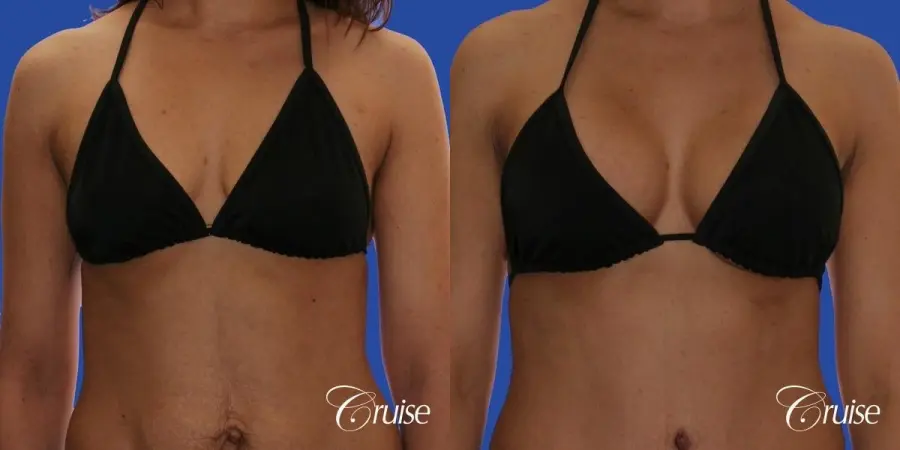 best scars for  breast lift anchor saline in Newport Beach, Orange County - Before and After 4