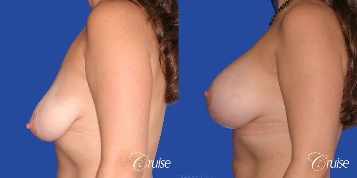 best results for breast lift surgeon in Newport Beach - Before and After 2