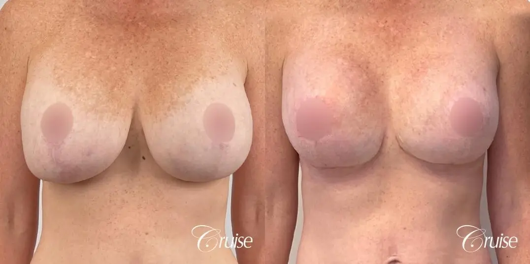 Breast Lift And Augmentation: Patient 72 - Before and After 1