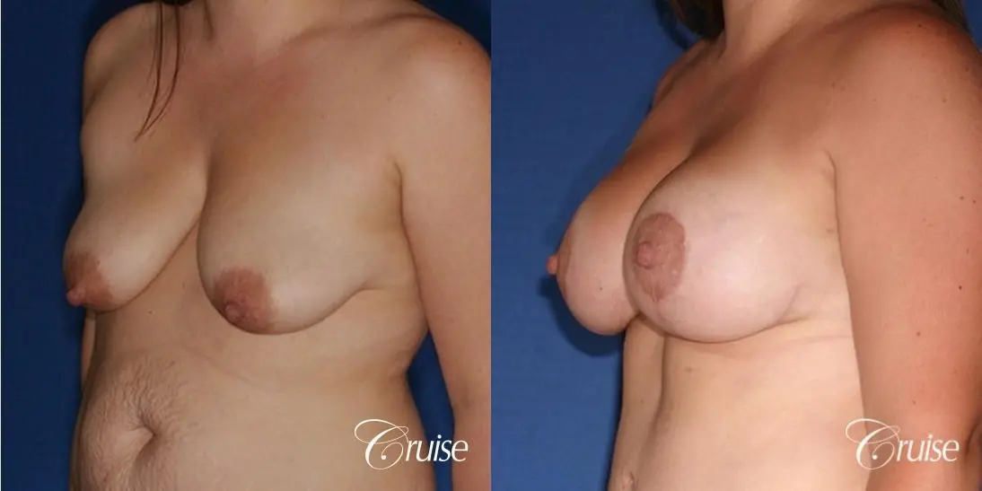 best results on young woman for breast lift anchor with saline augmentation - Before and After 3
