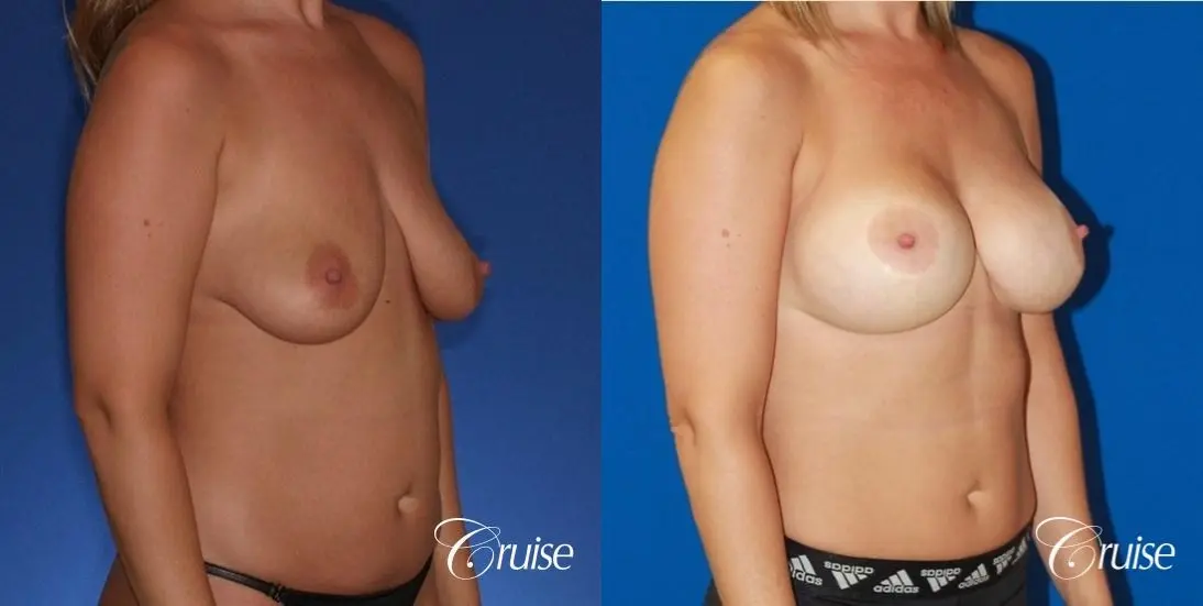 best before and after of breast lift anchor with high profile saline augmentation - Before and After 4
