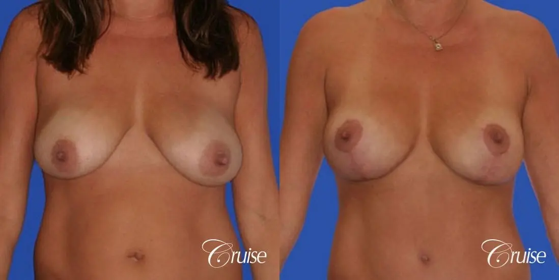 photos of best breast lift anchor with saline implants in Newport Beach - Before and After 1