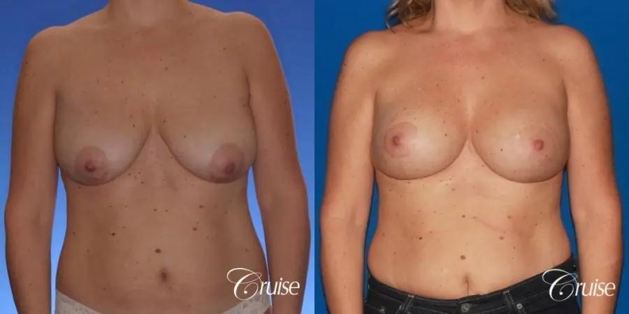 breast lift anchor on mature woman 21 - Before and After 1