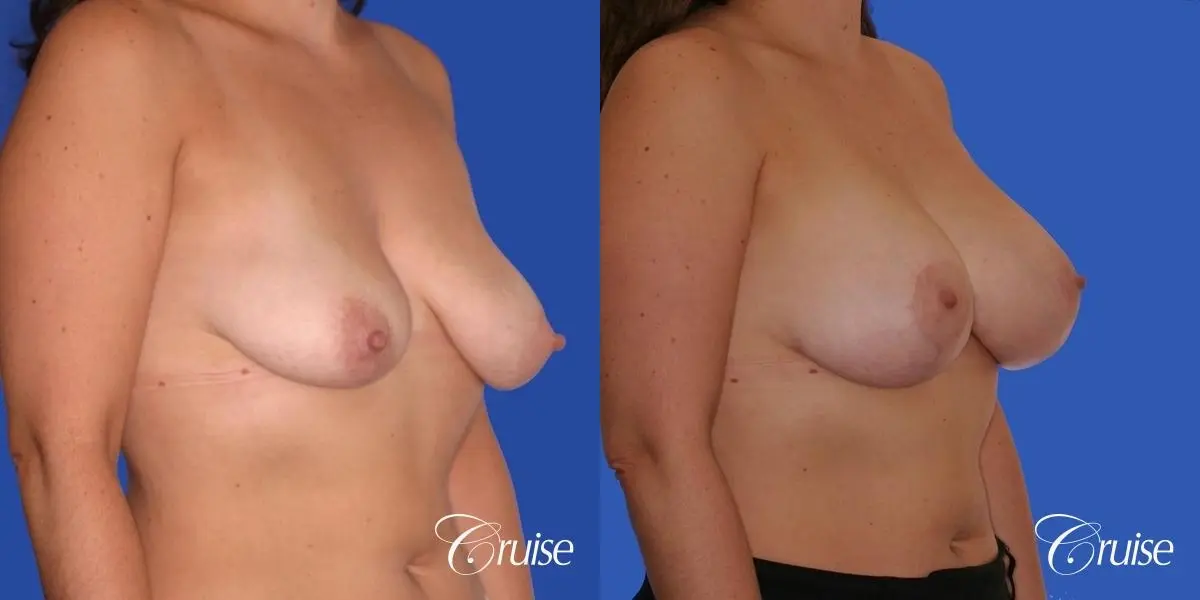 best results for breast lift surgeon in Newport Beach - Before and After 3