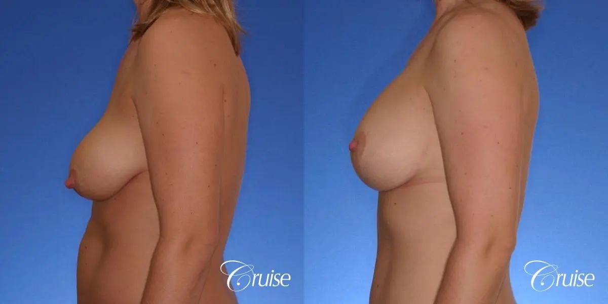 best breast lift anchor with silicone implants on 40 year old woman - Before and After 2