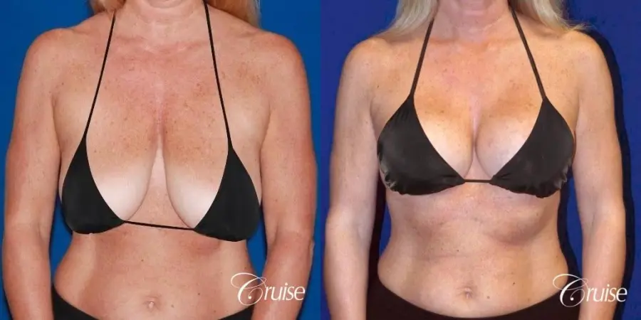 best breast lift with implants - Before and After 5