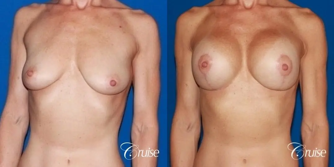 best breast lift results with high profile 375cc implants - Before and After 1