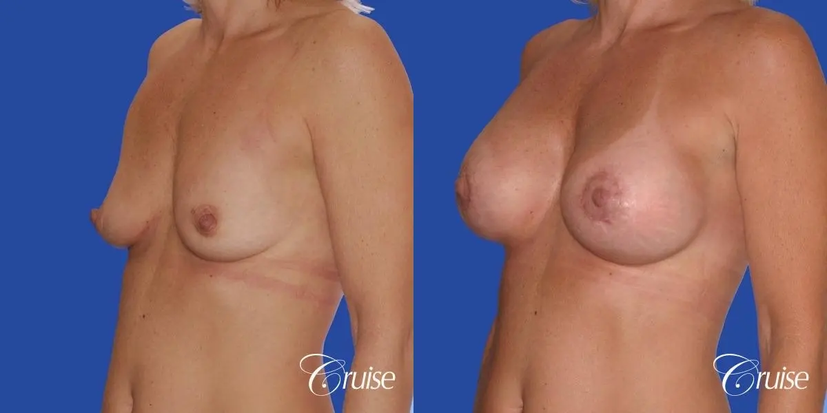 breast lift anchor with silicone implants on adult - Before and After 3