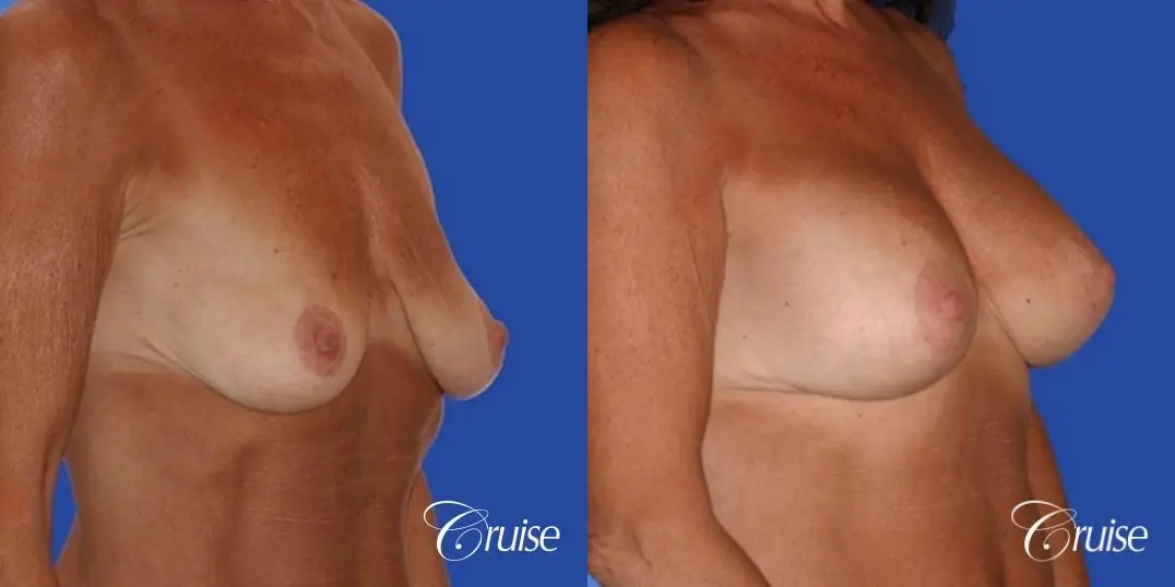 best results for breast lift in Orange County - Before and After 2