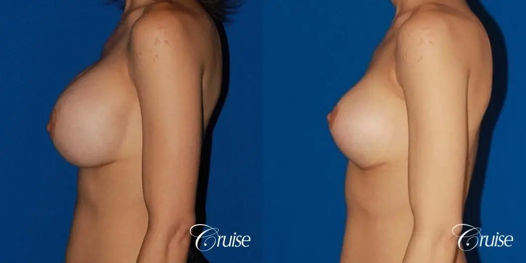 best breast lift revision with moderate profile silicone implants - Before and After 2