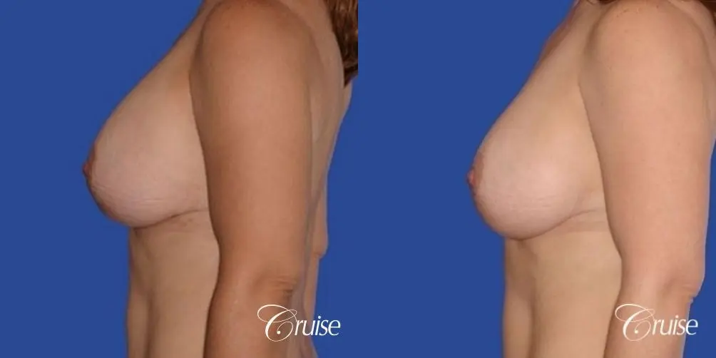 pictures of 42 yr old with breast lift anchor revision - Before and After 2