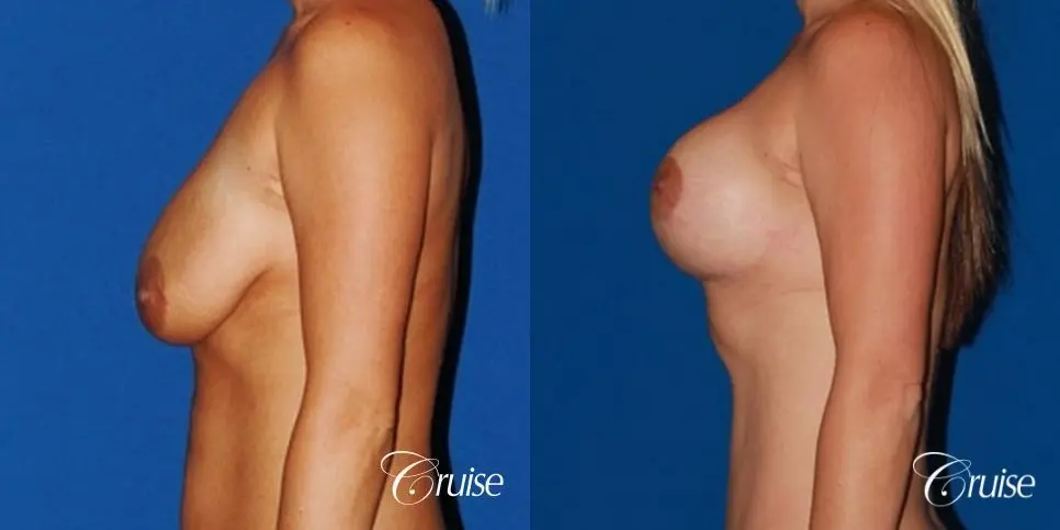 best breast lift anchor with saline implants - Before and After 2