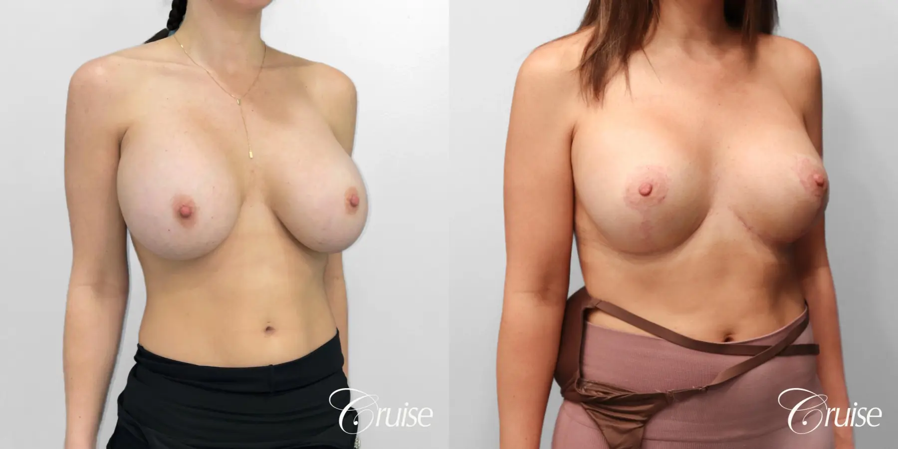 Breast Lift And Augmentation: Patient 77 - Before and After 3