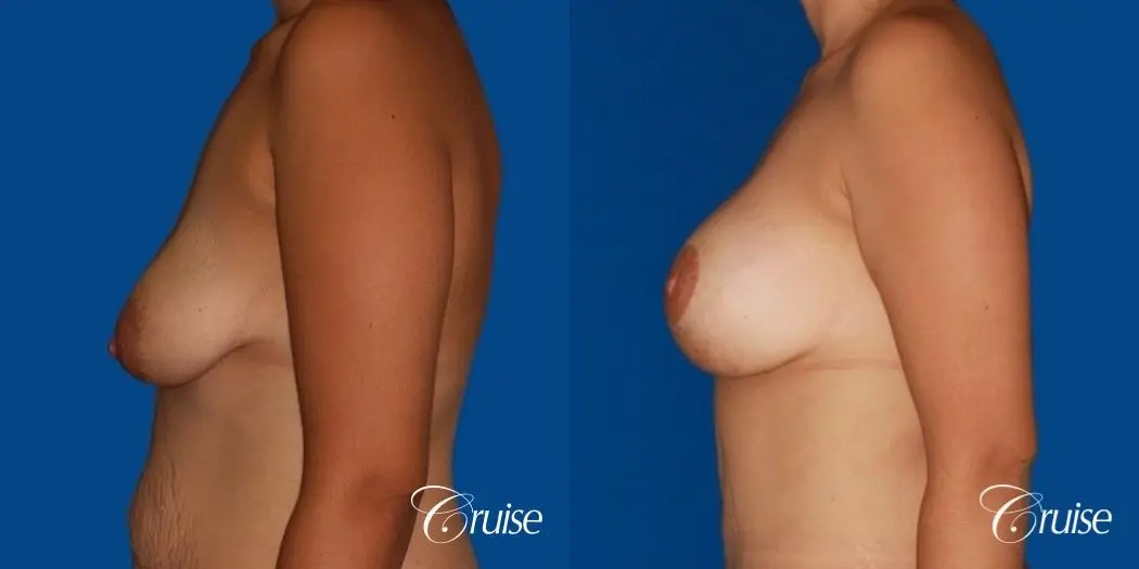 best breast lift anchor by top plastic surgeon in Newport Beach - Before and After 2