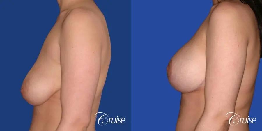 young woman who had best results for breast lift with saline implants - Before and After 2
