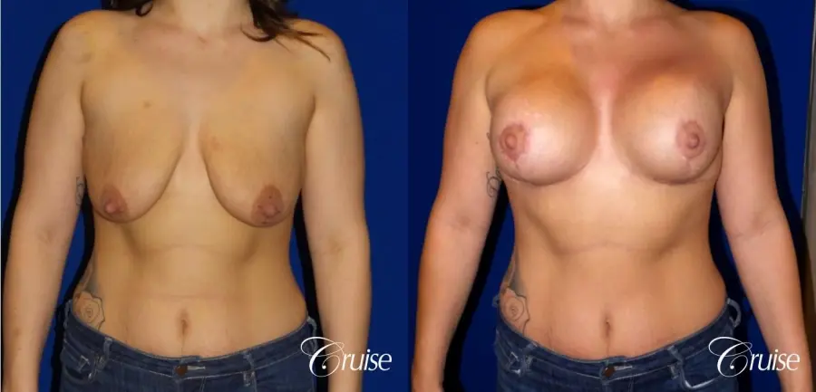 Breast Lift - Anchor w/ Saline Implants on Young Woman - Before and After 1