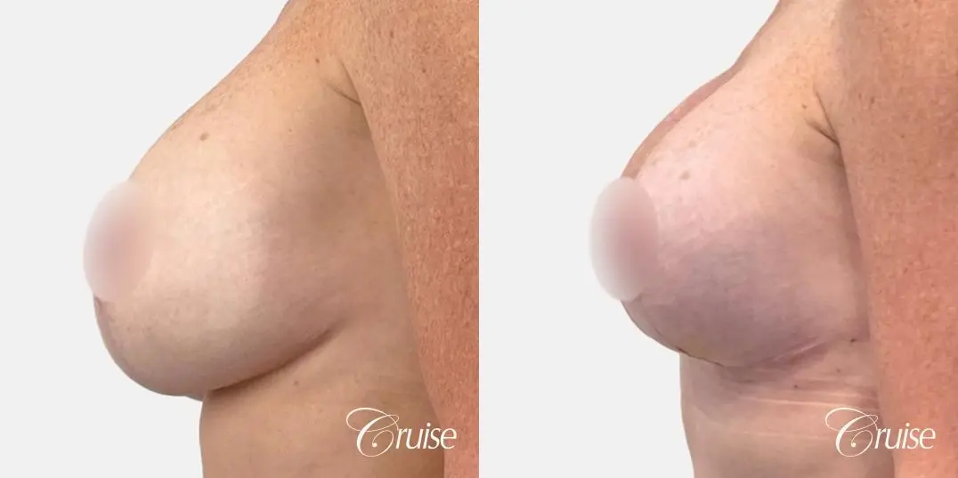 Breast Lift And Augmentation: Patient 72 - Before and After 3
