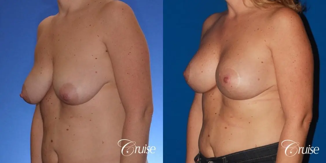 breast lift anchor on mature woman 21 - Before and After 3