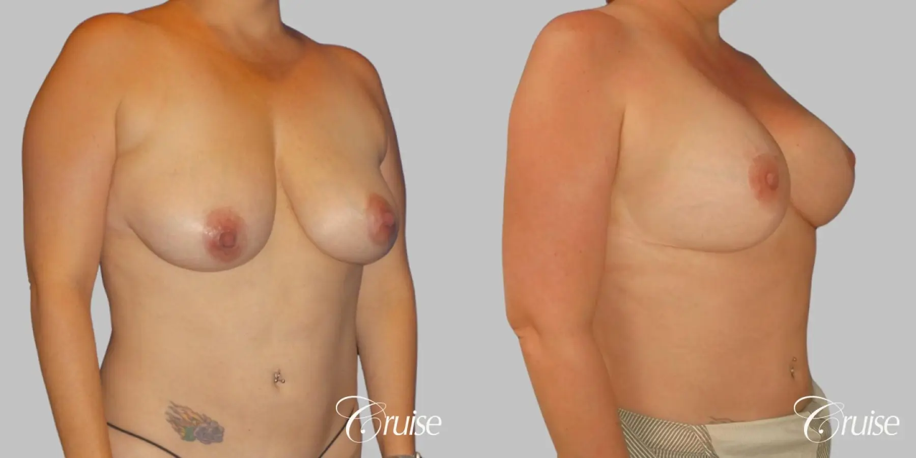 Breast Lift And Augmentation: Patient 3 - Before and After 2