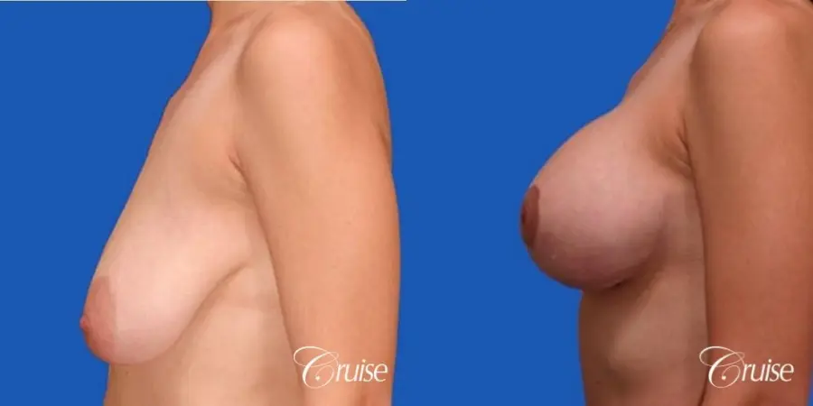 best results for breast lift anchor with top plastic surgeon - Before and After 2
