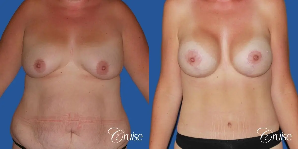 best mommy makeover and breast lift anchor results - Before and After 1