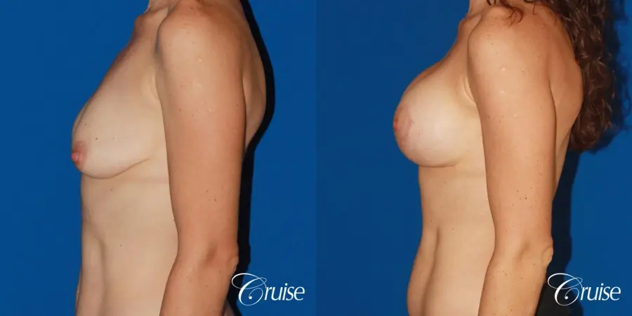 young woman with silicone breast lift anchor - Before and After 2