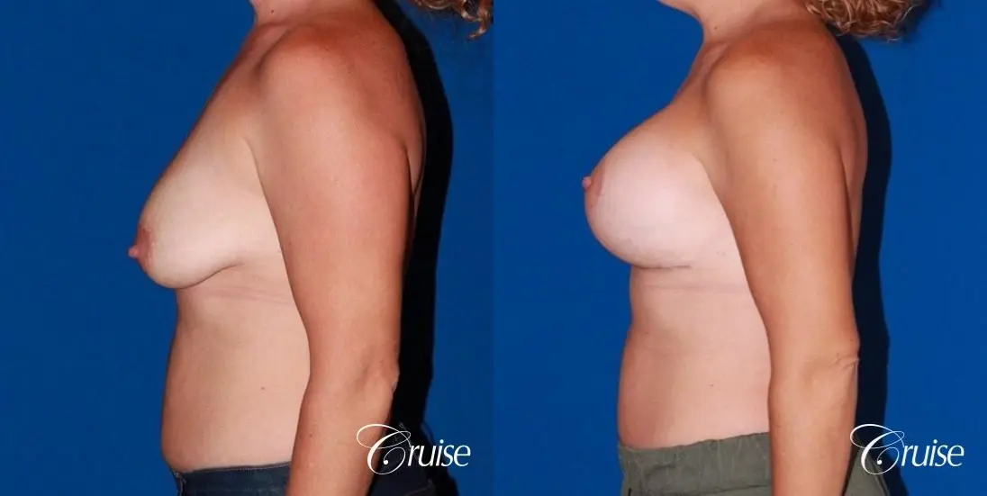 best results for breast lift anchor with saline implants - Before and After 2