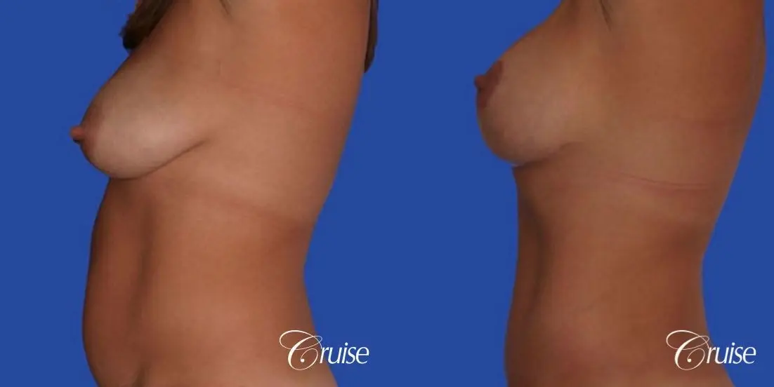 photos of best breast lift anchor with saline implants in Newport Beach - Before and After 2