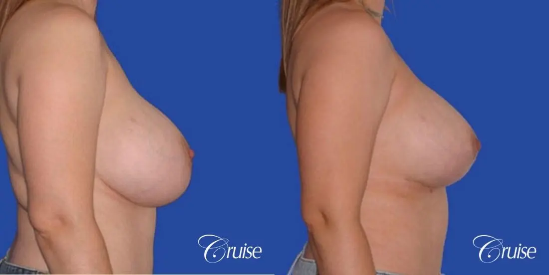 best revision Breast Lift with saline implants - Before and After 2
