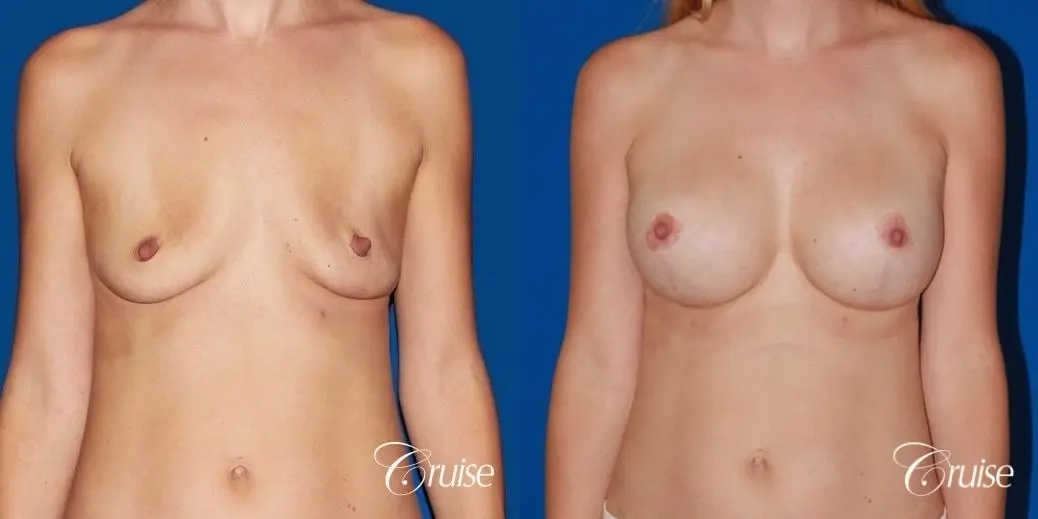 best breast lift anchor with High profile silicone 500cc implants - Before and After 1