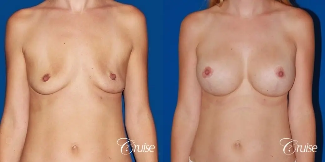 best breast lift anchor with High profile silicone 500cc implants - Before and After