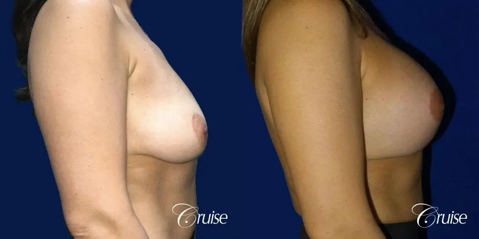 Breast Lift Anchor W/ Silicone Implants On Young Woman - Before and After 2