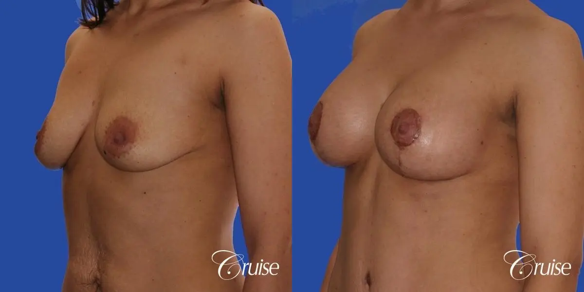 best scars for  breast lift anchor saline in Newport Beach, Orange County - Before and After 3