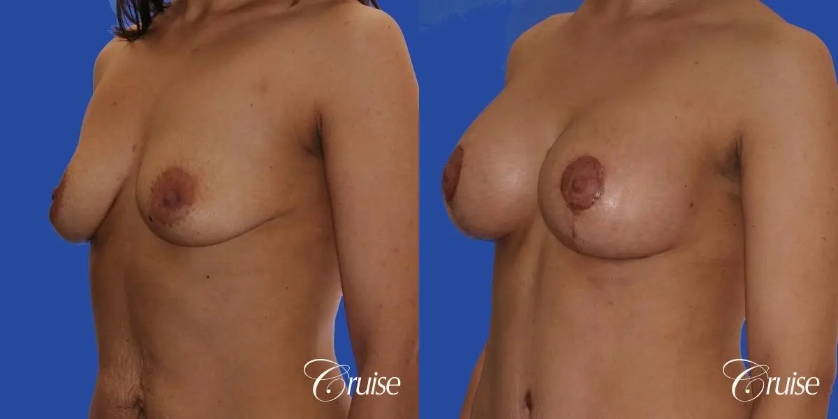 best scars for breast lift anchor saline in Newport Beach, Orange County - Before and After 3
