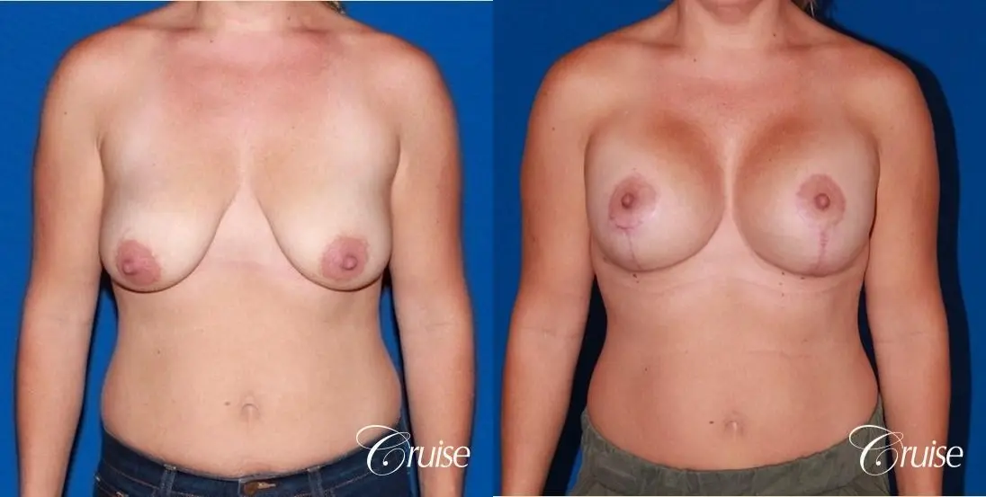 best results for breast lift anchor with saline implants - Before and After 1