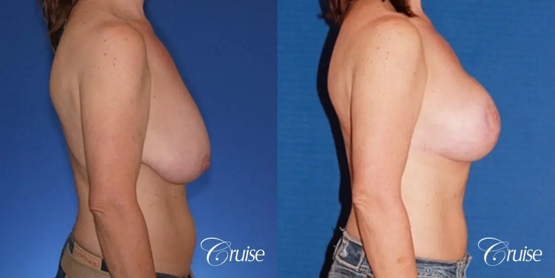 best breast lift anchor with high profile saline implants - Before and After 3