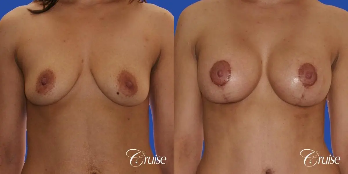 best scars for  breast lift anchor saline in Newport Beach, Orange County - Before and After 1